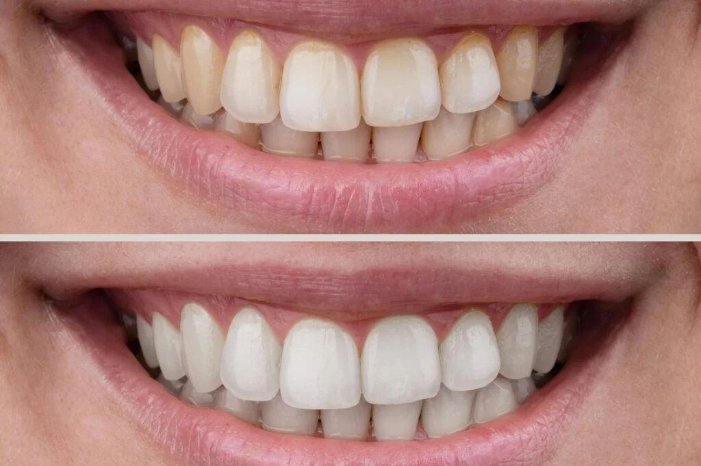 Quick Teeth Whitening Options: What Works Fast and What to Avoid